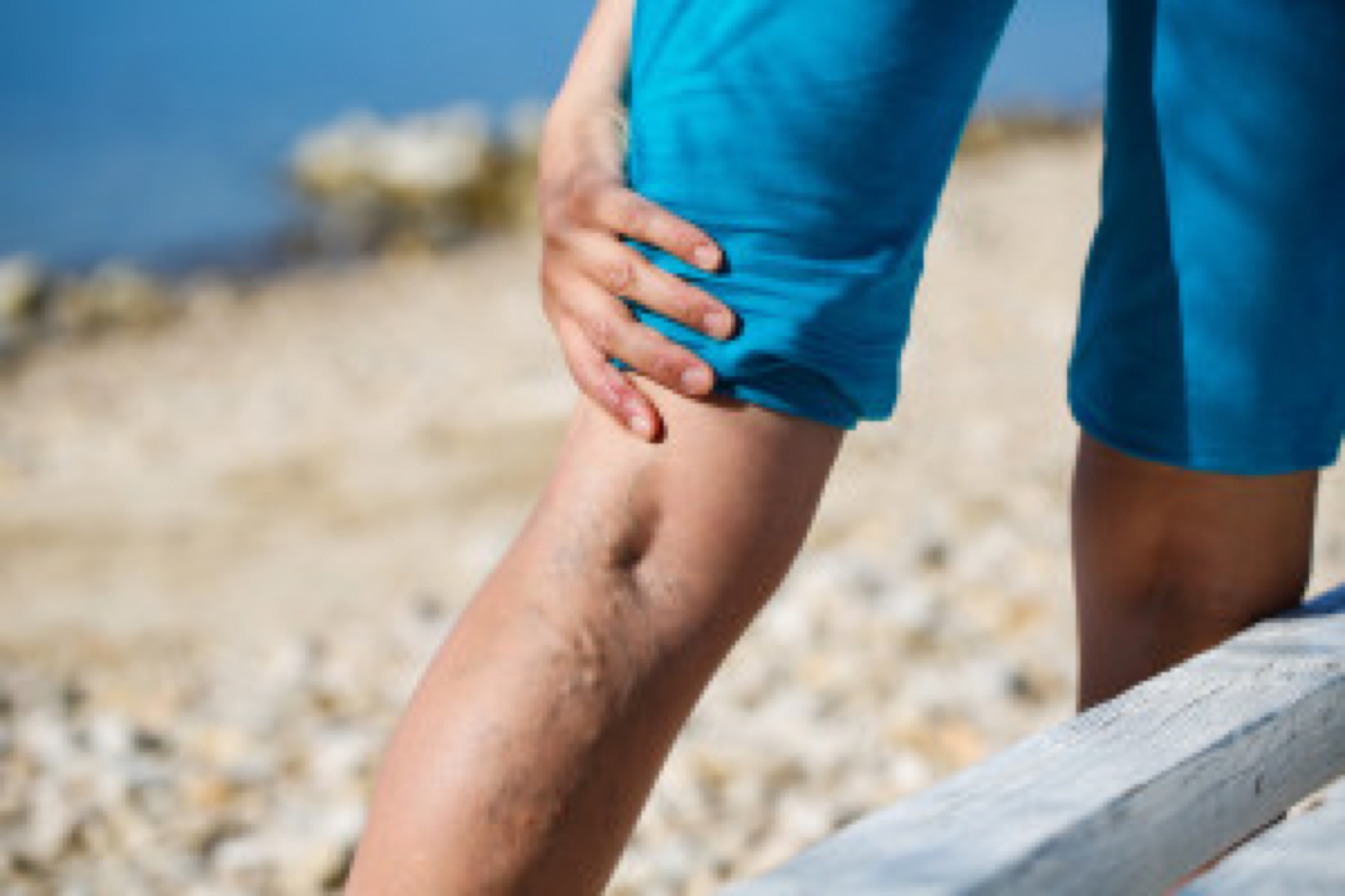 Woman touching painful varicose veins on a leg