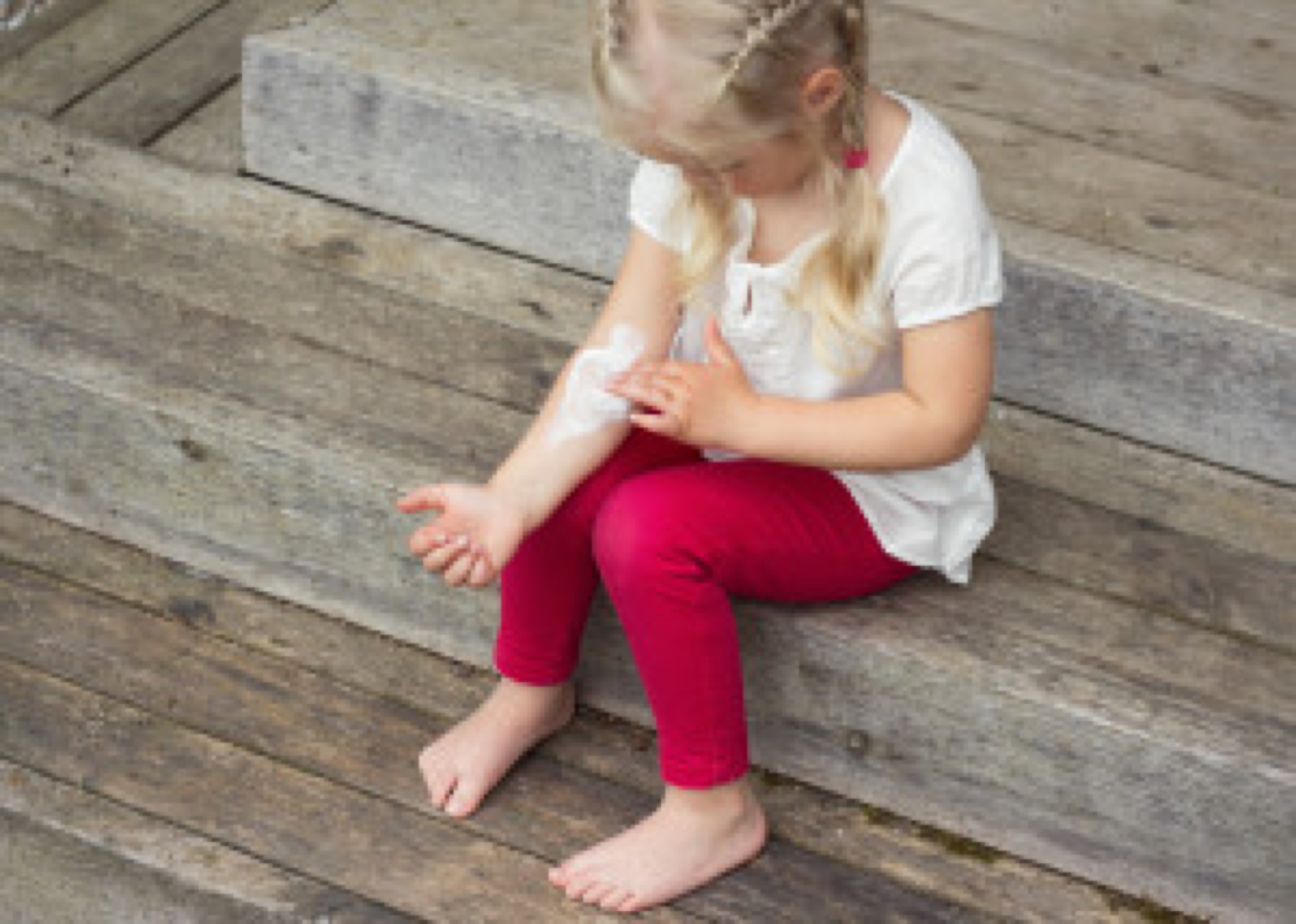 Girl applying cream on allergic skin, eczema treatment