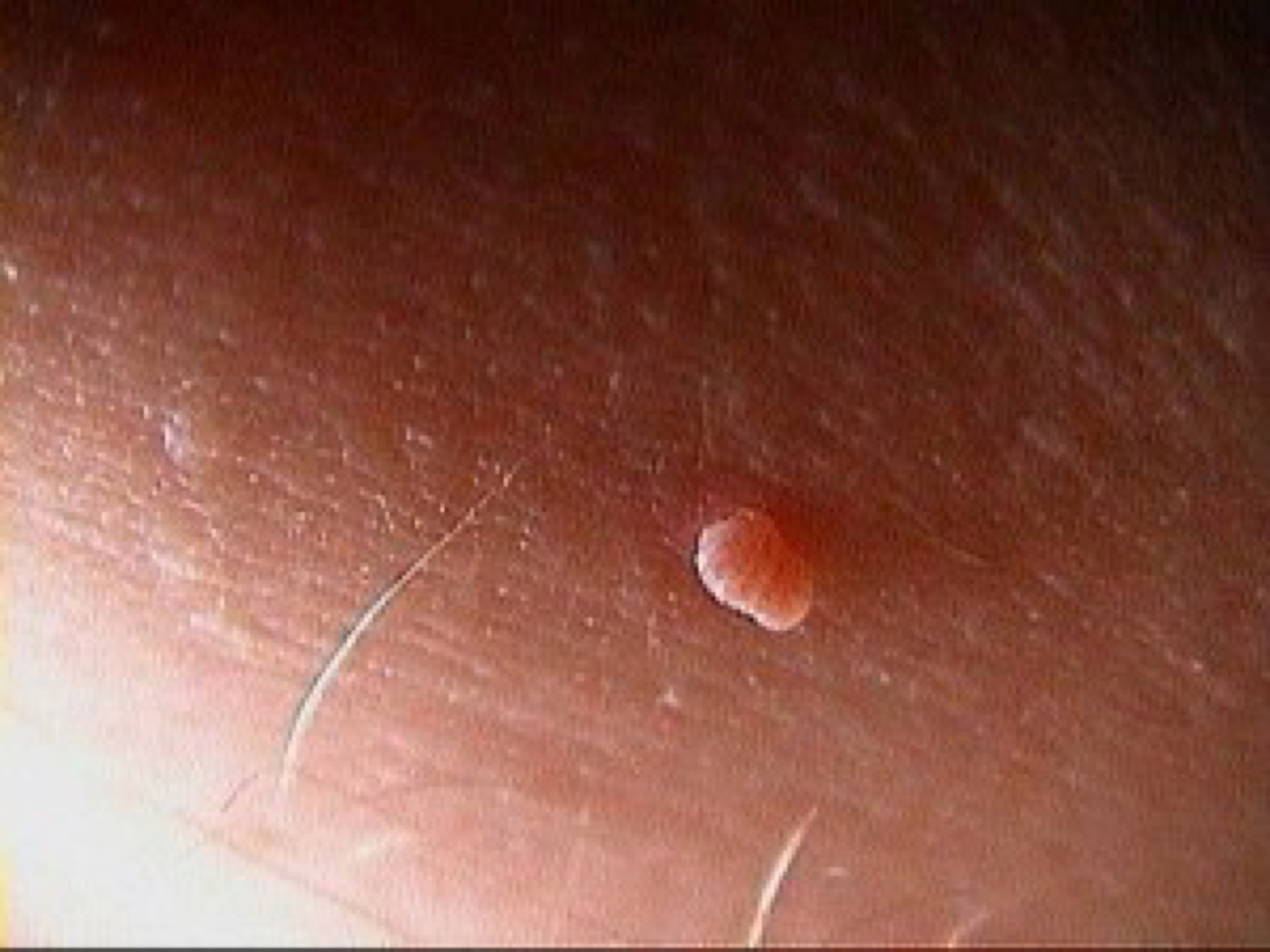 genital warts vs skin tags genital warts vs skin tags