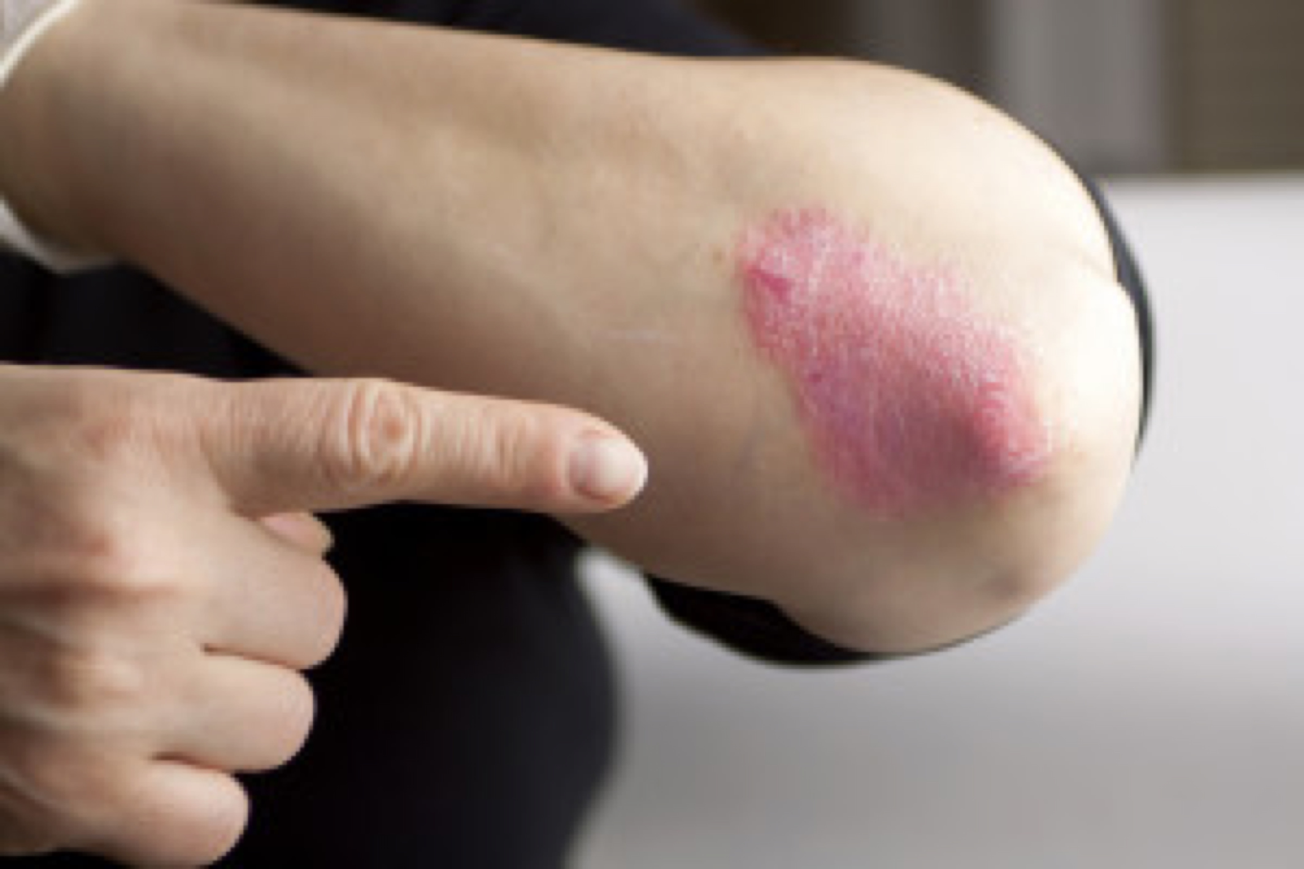 Psoriasis on elbow. Close-up