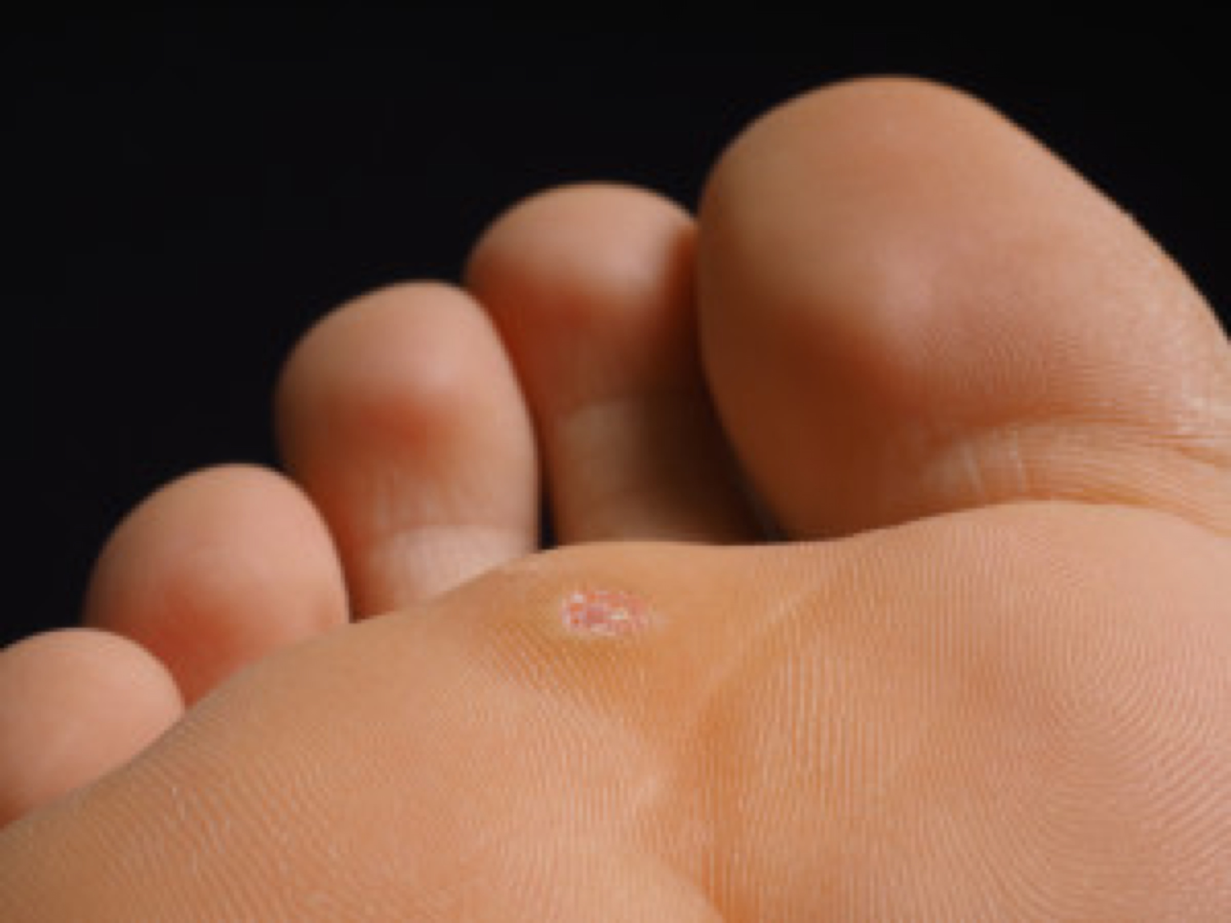 Closeup of foot with a infected wart placed under toes, isolated towards black