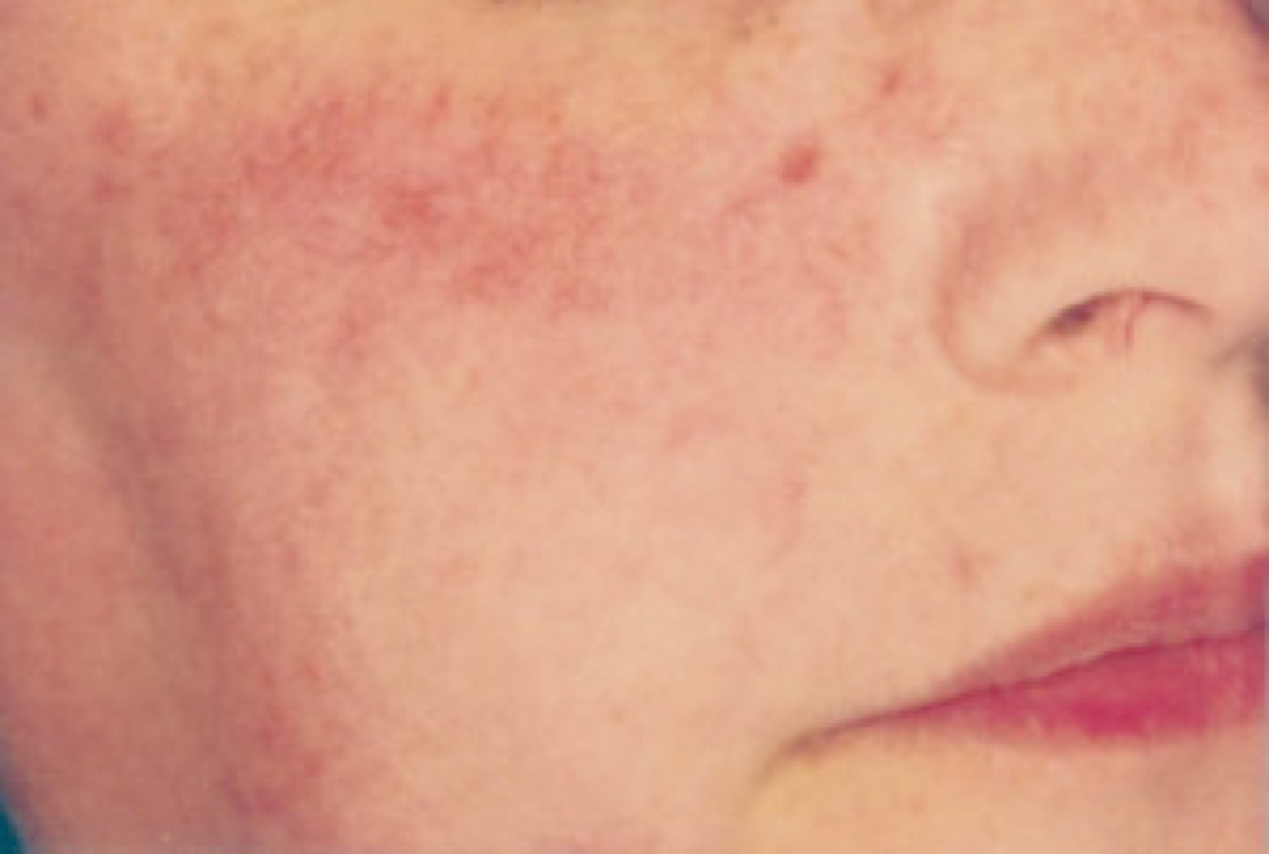 blog image - rosacea 2