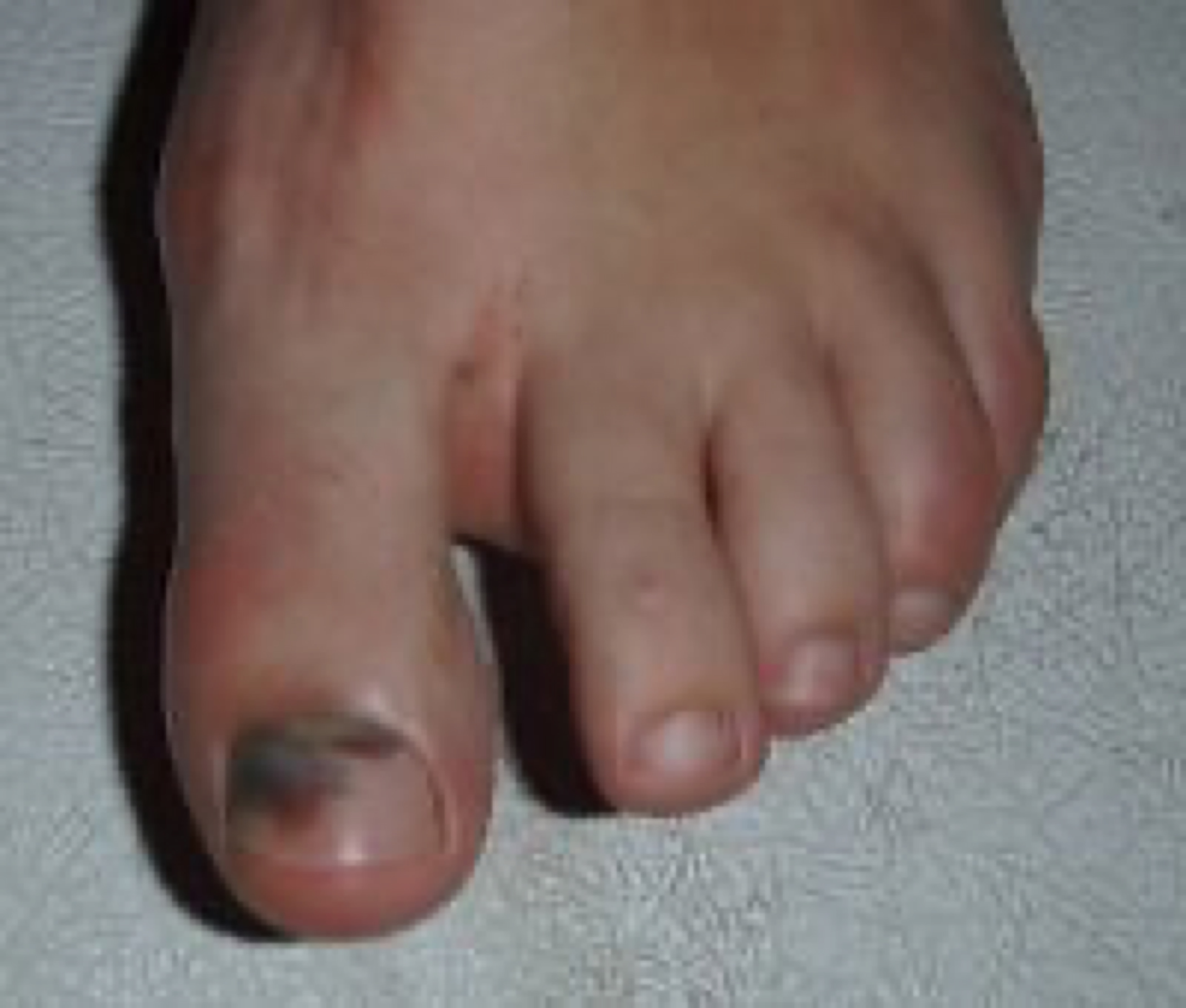 blog image - black toenail
