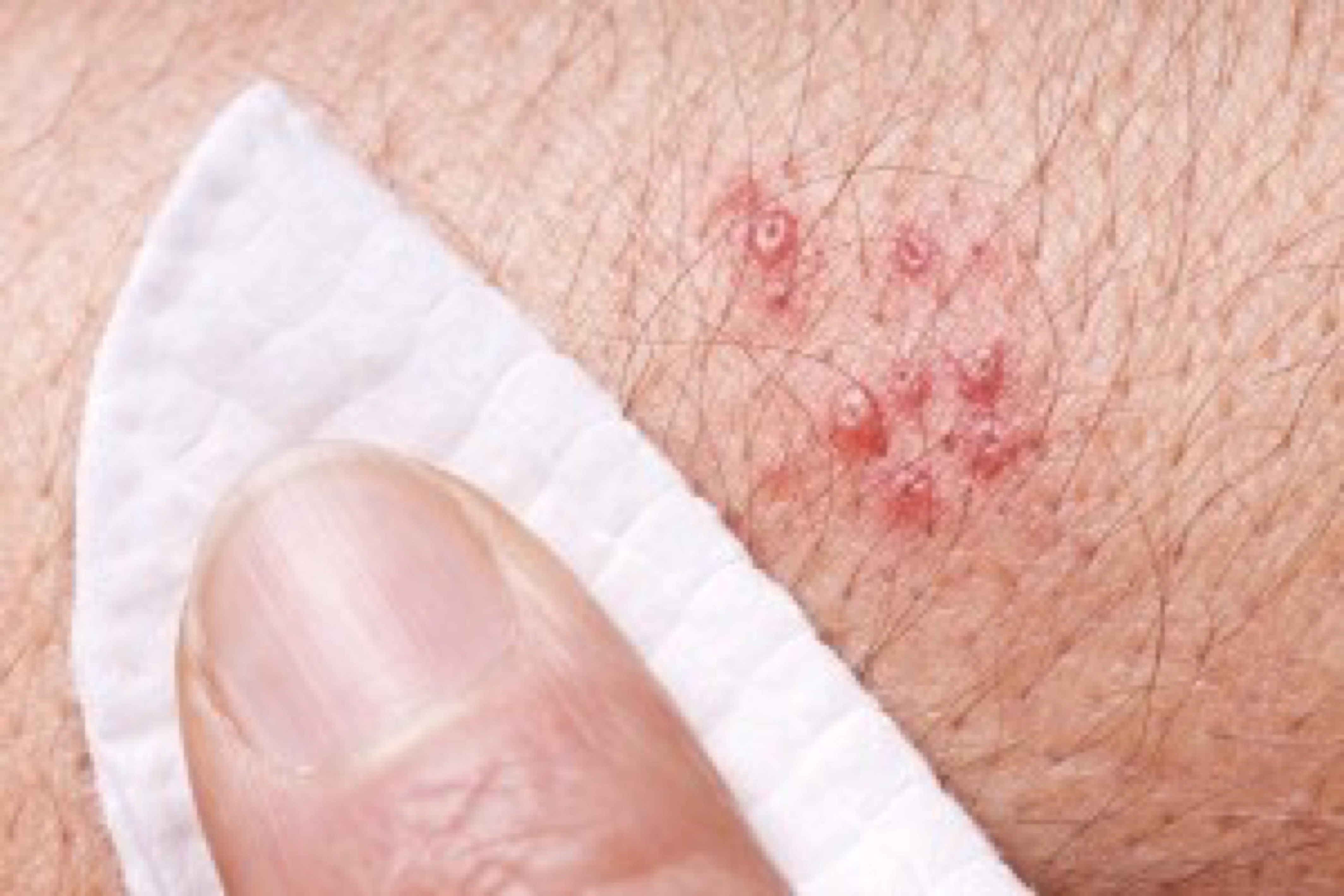 Stress levels or herpes zoster (shingles) rash with blisters on the left hand