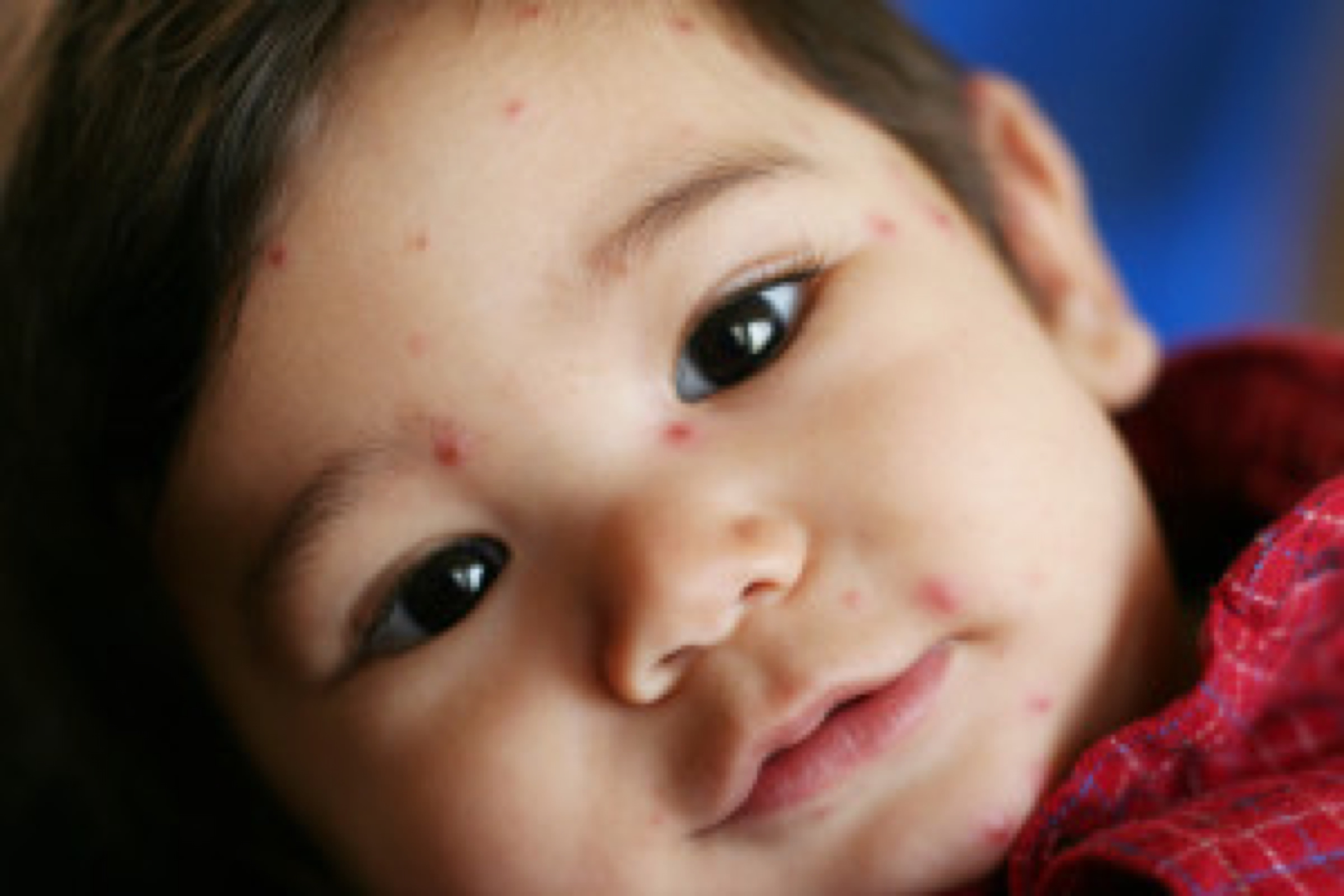 Baby with Chicken Pox