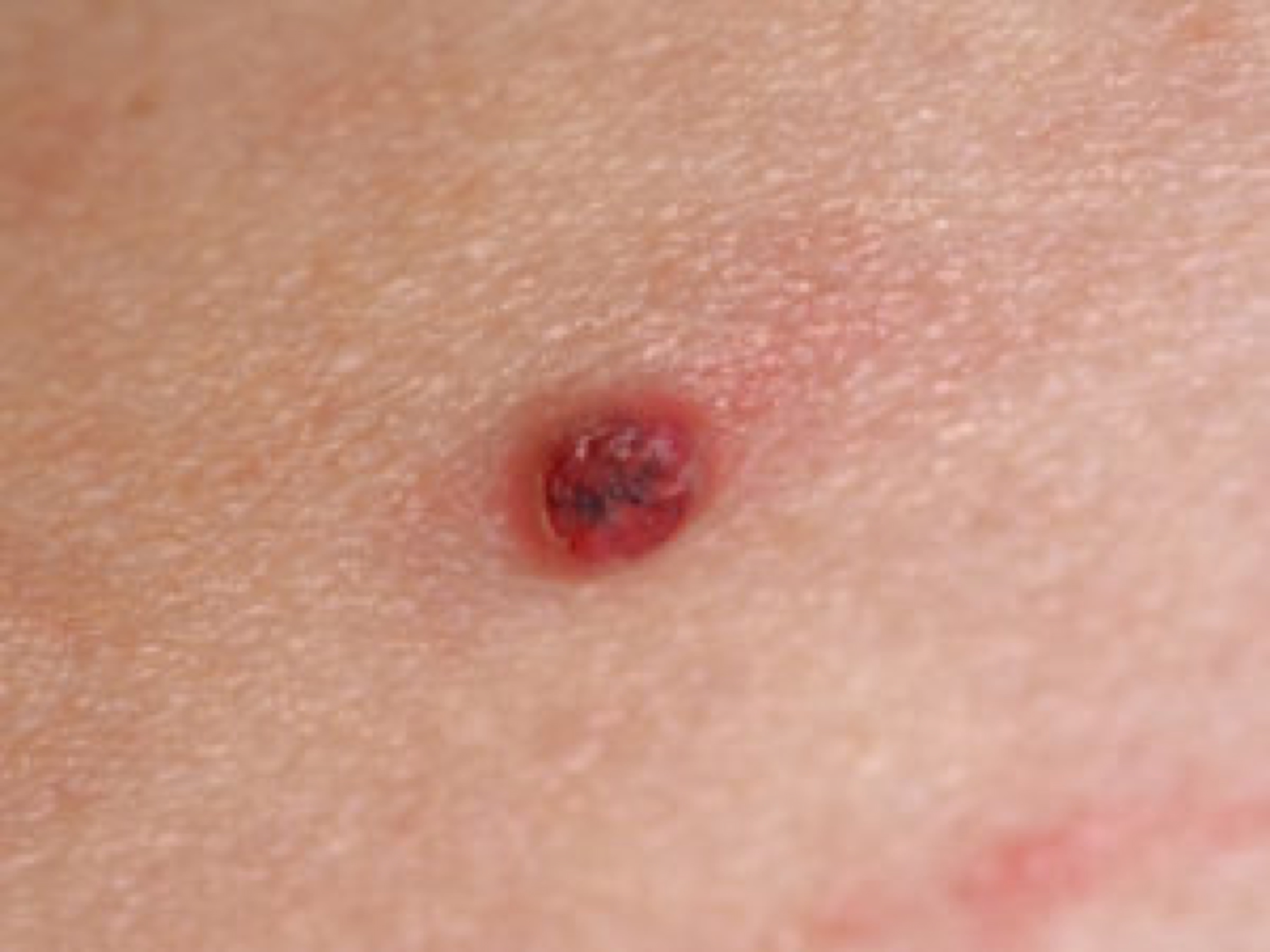 what-is-granuloma-annulare-and-how-can-this-condition-be-helped