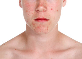 acne on young man