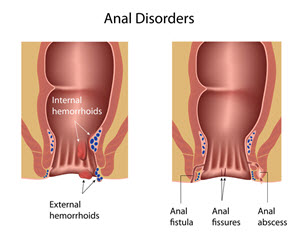 anal disorders, fissures
