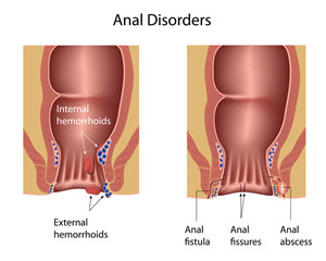 Anal Fissures Causes Symptoms and Treatment Healing Natural Oils