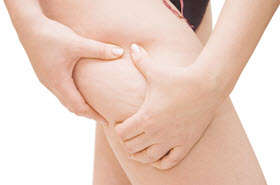 cellulite on woman's leg