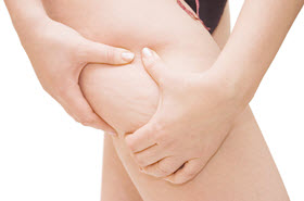 Cellulite, Causes & Treatment