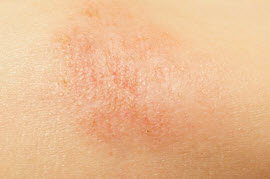 eczema rash